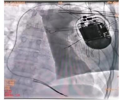 常德市四医院成功完成首台埋藏式心脏复律除颤器(ICD)植入